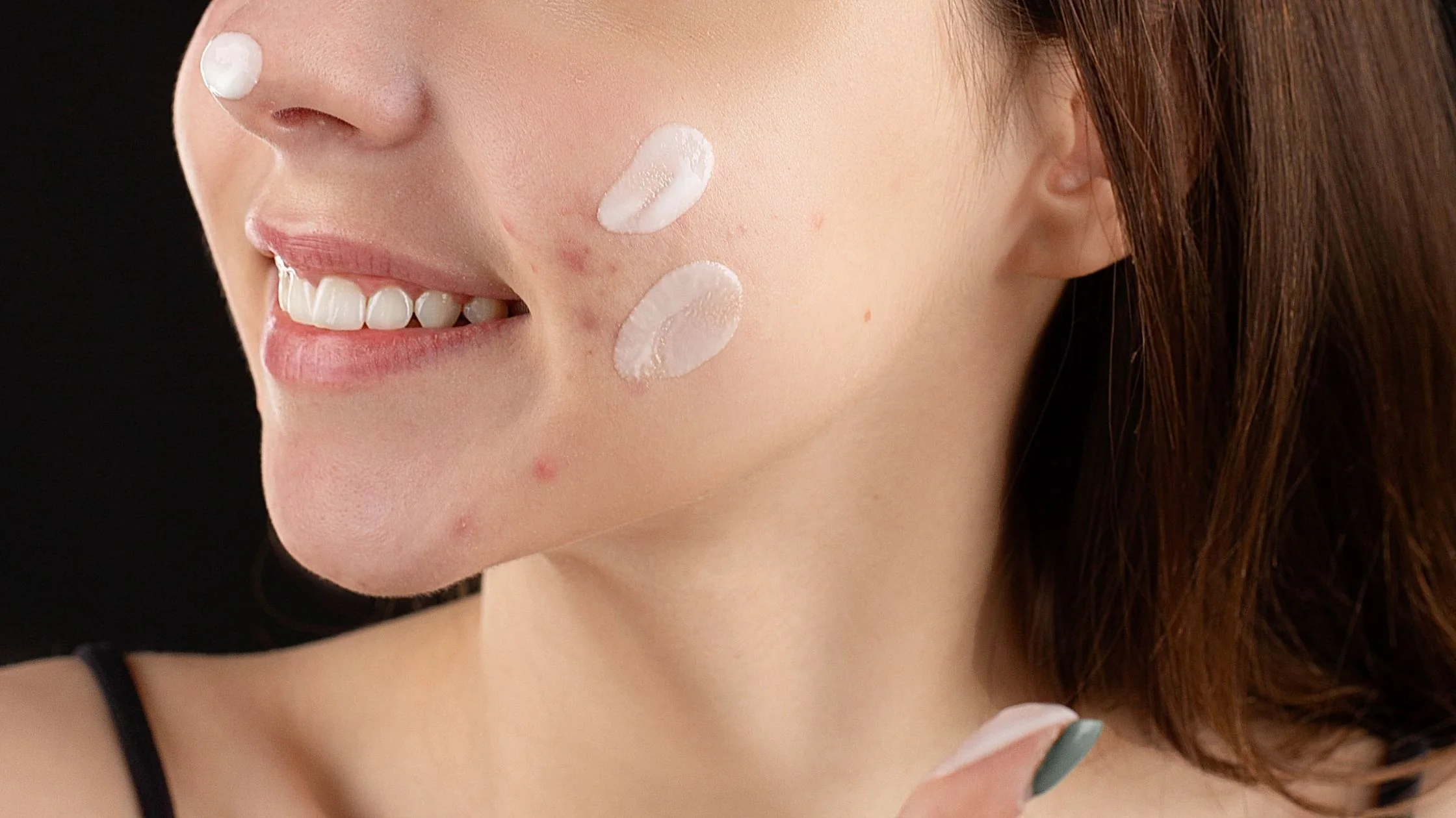 Niacinamide for Acne: How It Fights Breakouts, Reduces Redness & Controls Oil