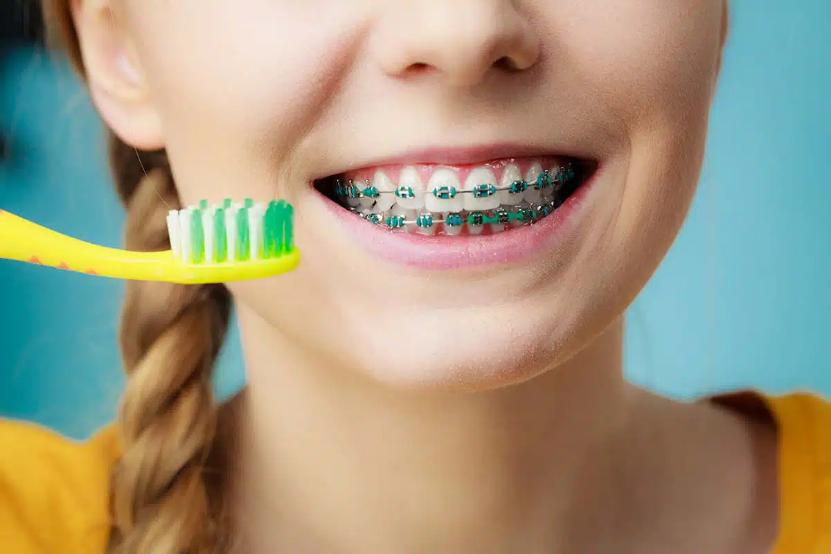 How to Care for Your Teeth with Braces: Do’s and Don’ts