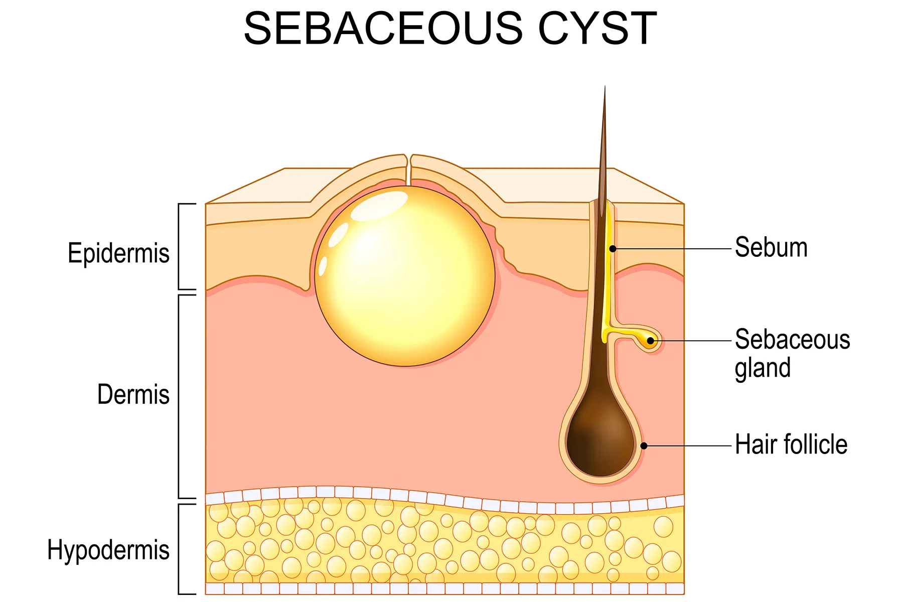 Best Reasons to See an Affordable Dermatologist London for Removing Sebaceous Cyst