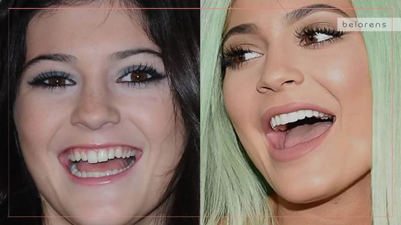 Celebrity Dental Implants and Veneers Before and After