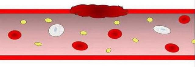 can you die from low platelets