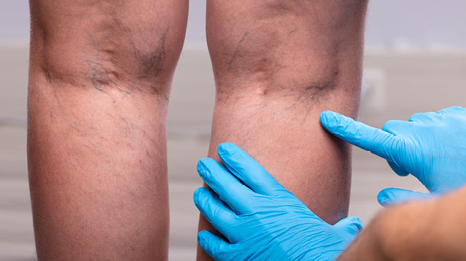 Varicose Vein
