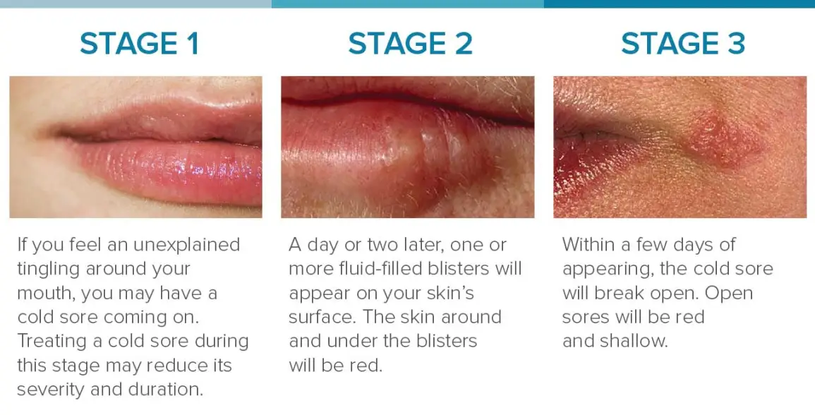 Herpes Photos in Different Stages