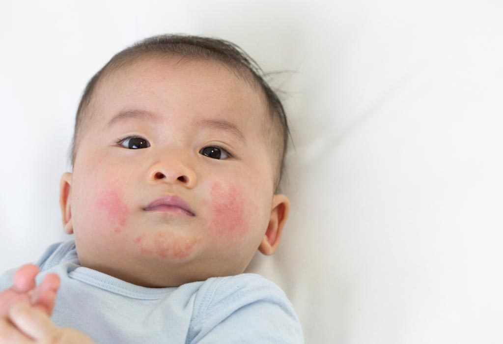 Teething Rash on Face