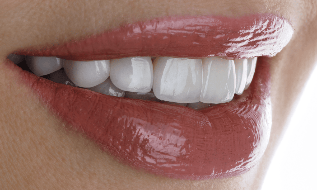 Porcelain vs Composite Veneers in Singapore Which One Will Still Look Perfect in 10 Years