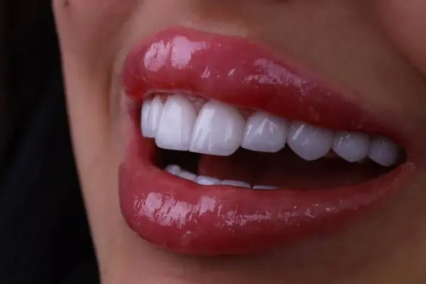 Dental Tourism in Turkey from the UK What to Check Before You Book (It's More Than a Hollywood Smile)