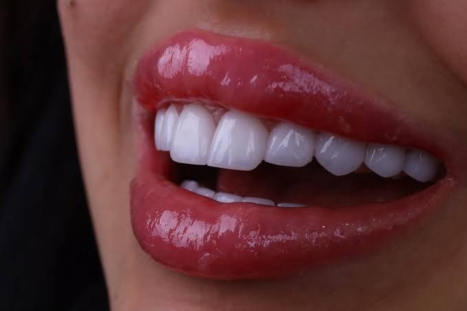 Dental Tourism in Turkey from the UK What to Check Before You Book (It's More Than a Hollywood Smile)